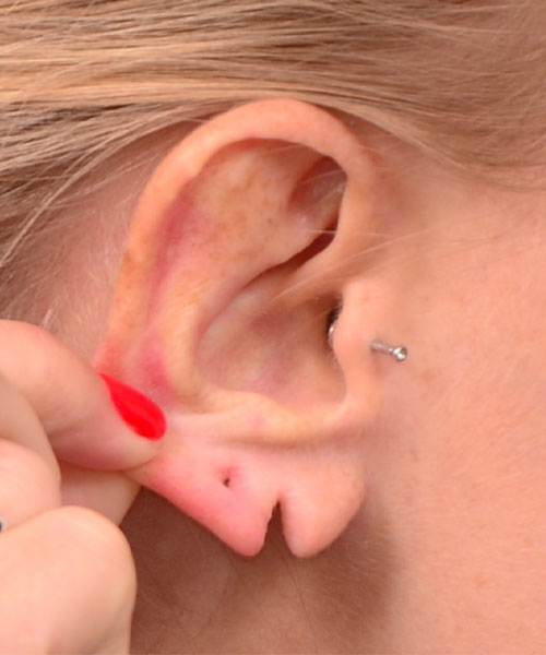 Ear lobe repair